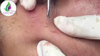 Satisfying acne blackhead relaxing with NASA SPA Beauty 001 [upl. by Nelle519]