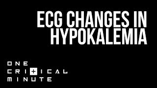 ECG Changes in Hypokalemia  One Critical Minute 1CM [upl. by Kevina]