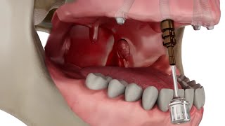 Straumann Pro Arch Step by Step Overview [upl. by Emalee]