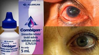 Combigan Eye Drop For Ocular Hypertension glaucoma  Brimonidine  Timolo [upl. by Lechner113]