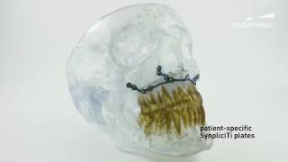 PatientSpecific CranioMaxillofacial CMF Implants  Materialise SynpliciTi [upl. by Mattland56]