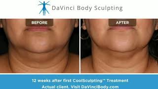 WOW Stunning CoolSculpting Chin Results [upl. by Willis]