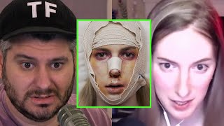 ContraPoints Talks On The Trauma Of TransFacial Surgery [upl. by Deckert]