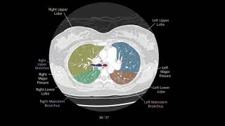 How to read HRCT chest axial view with voice [upl. by Wampler]