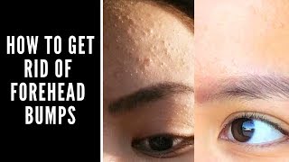 How to Get Rid of Forehead Bumps [upl. by Reiser]