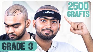 Grade 3 Baldness Surgery 2500 Grafts 😎  Hair Transplant in Bangladesh  New Roots [upl. by Aicilf]