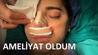 AMELİYAT OLDUM  BURNUMU NASIL KESTİLER [upl. by Iatnwahs412]