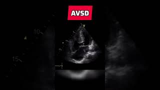 Atrioventricular septal defect  congenital heart defect echocardiography AVSD [upl. by Intyrb]