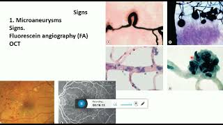 daibetic retinopathy signs and ETDRS classification [upl. by Brink311]