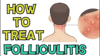 HOW TO TREAT FOLLICULITIS FAST [upl. by Eatton]