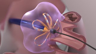 St Josephs Hospital Afib Patient Story  Hybrid Ablation Procedure [upl. by Ecilegna]