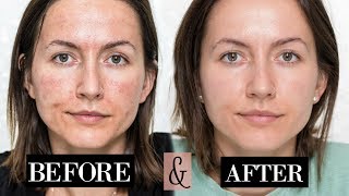 My MICRONEEDLING Experience  Skin Updates  Before amp After [upl. by O'Brien220]