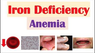 IronDeficiency Anemia Overview  Causes Pathophysiology Signs amp Symptoms Diagnosis Treatment [upl. by Eilrahc736]