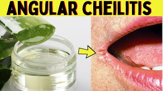 Home remedies to get rid of angular cheilitis naturally and fast in few hours [upl. by Sosthenna47]