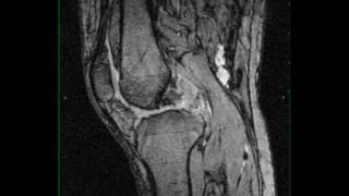 Pigmented Villonodular Synovitis Knee [upl. by Meibers46]