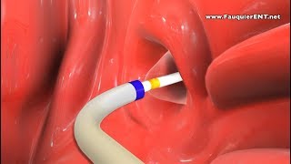 Balloon Eustachian Tube Dilation to Treat Eustachian Tube Dysfunction [upl. by Adnohsed]