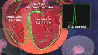 ¿Por qué se produce la taquicardia ventricular [upl. by Elleivad581]