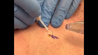 Satisfying Mole Removal [upl. by Xenia]