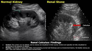 Renal Stone Kidney Ureter amp Bladder KUB Ultrasound Report Example  Renal Calculus USG Scan [upl. by Elvera]