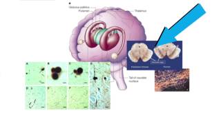 Curing Parkinsons by transplanting cells [upl. by Ambie]