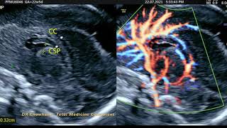 PARTIAL Agenesis of Corpus Callosum [upl. by Mcfarland]