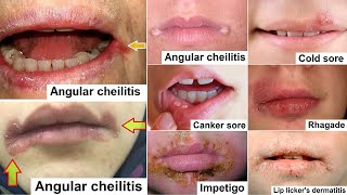 angular cheilitis Revised [upl. by Odawa]