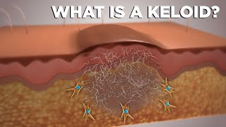 WHAT IS A KELOID [upl. by Eidur]