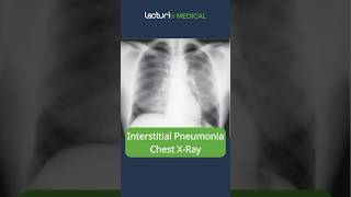 Understanding Interstitial Pneumonia 🫁 MedicalEducation usmle [upl. by Roswell478]