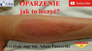 OPARZENIE jak leczyć Oparzenie co robić Oparzenia słoneczne leczenie [upl. by Jefferey]