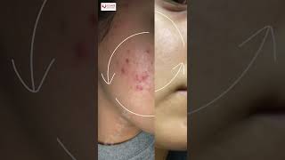 Acne Scars Before After Results at Clair Skin Clinic  Best Acne Scars Treatment in Delhi shorts [upl. by Marquis]