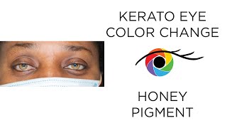 Eye Color Change from Dark to Light Brown with Kerato Honey Pigment [upl. by Esmerolda]