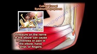 Cubital Tunnel Syndrome  Everything You Need To Know  Dr Nabil Ebraheim [upl. by Naired]