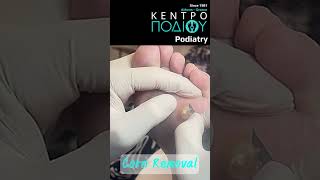 Corn Removal κεντροποδιου kentropodiou podiatry podiatria podologia podology podiatrist [upl. by Fazeli]