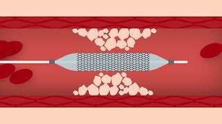 Heart Stent Procedure [upl. by Smailliw]