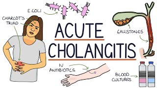 Understanding Acute Cholangitis Ascending Cholangitis [upl. by Locin64]