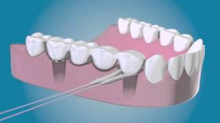 TePe Bridge amp Implant Floss  für die Reinigung um die Implantate [upl. by Adrianna]