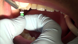 root canal treatment part 1 [upl. by Adnoek]