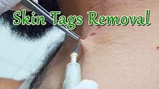 How to Remove Skin Tags around Neck with Electric Cautery  Skin Tag Removal Procedure [upl. by Llenhoj789]