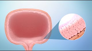 Treatment for Bladder Cancer [upl. by Eniluj139]