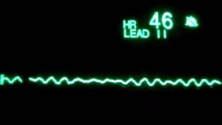 Fine Ventricular Fibrillation [upl. by Anib]