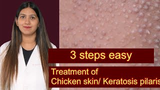 Keratosis pilaris treatment  chicken skin disease  bumps on upper arms  clogged pores treatment [upl. by Domph]