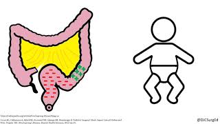 Hirschsprungs Disease [upl. by Hanley]