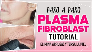 PLASMA PEN FIBROBLAST paso a paso  Rostro cuello doble mentón  plasma pen CarolinaSKB plasmapen [upl. by Bak]