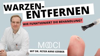 Warzen entfernen  Wie geht das [upl. by Ardell]