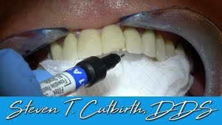 How to Bond a Chipped Porcelain Bridge  Dental Minute with Steven T Cutbirth DDS [upl. by Johnson]