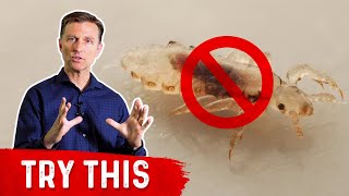 Head Lice Best Home Remedy [upl. by Melvyn]