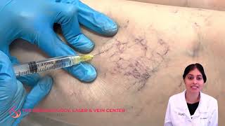 CO2 Laser Resurfacing Treatment For Getting Rid of Scars  Full Procedure [upl. by Niggem214]