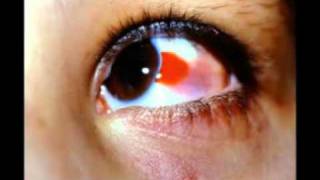 Subconjunctival Hemorrhage [upl. by Yddet]