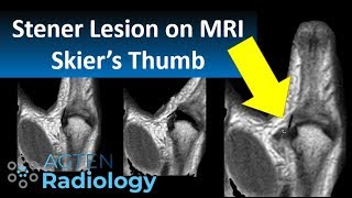 Stener Lesion Skiers Thumb on MRI [upl. by Kcirb676]