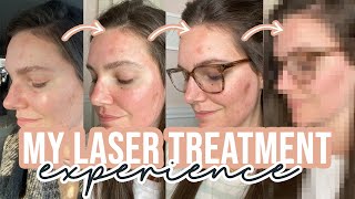 LaseMD Laser Treatment Before amp After  Fixing My Skin  Sarah Brithinee [upl. by Venable209]